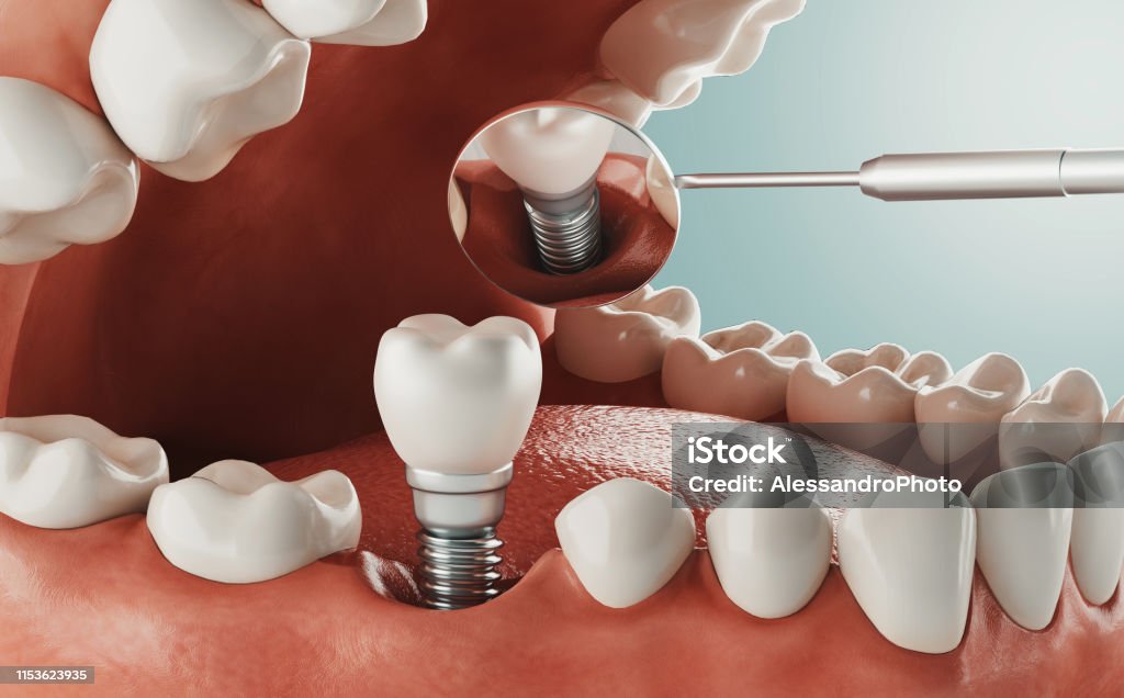 Trồng răng implant