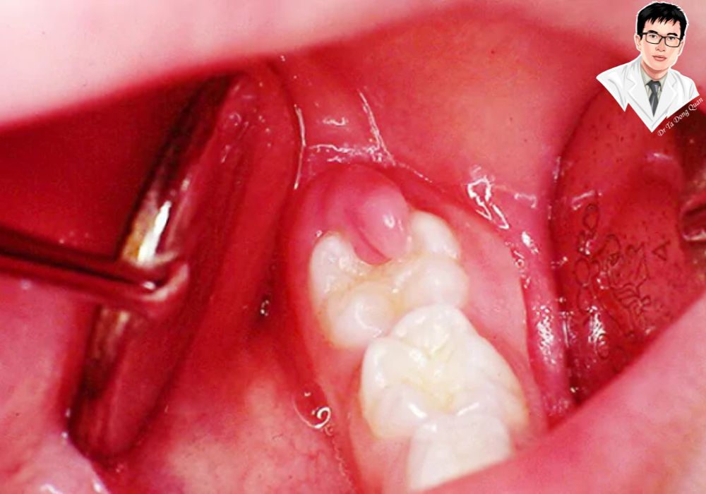 Lợi trùm sưng viêm nghiêm trọng nếu không điều trị kịp thời có thể dẫn đến nhiều biến chứng nguy hiểm. Lợi trùm sưng viêm nghiêm trọng nếu không điều trị kịp thời có thể dẫn đến nhiều biến chứng nguy hiểm.