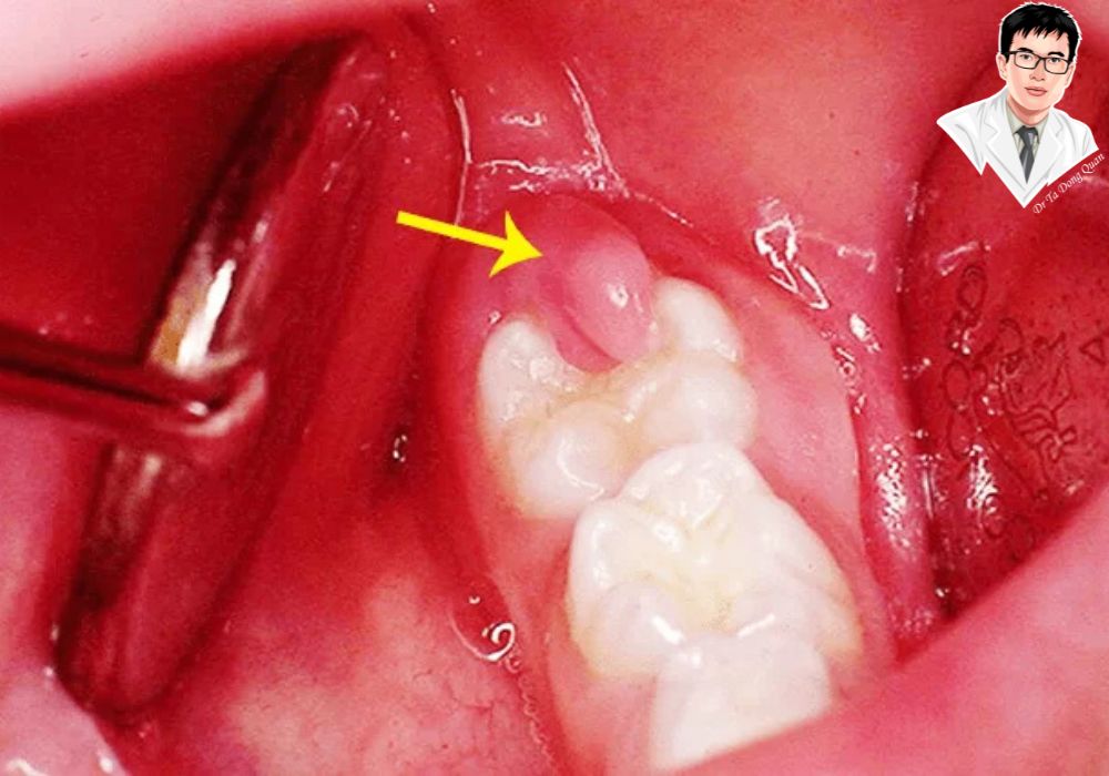 Phẫu thuật cắt lợi trùm giúp giải thoát răng khôn khỏi sự bao phủ của lợi, giảm đau và ngăn ngừa biến chứng Phẫu thuật cắt lợi trùm giúp giải thoát răng khôn khỏi sự bao phủ của lợi, giảm đau và ngăn ngừa biến chứng