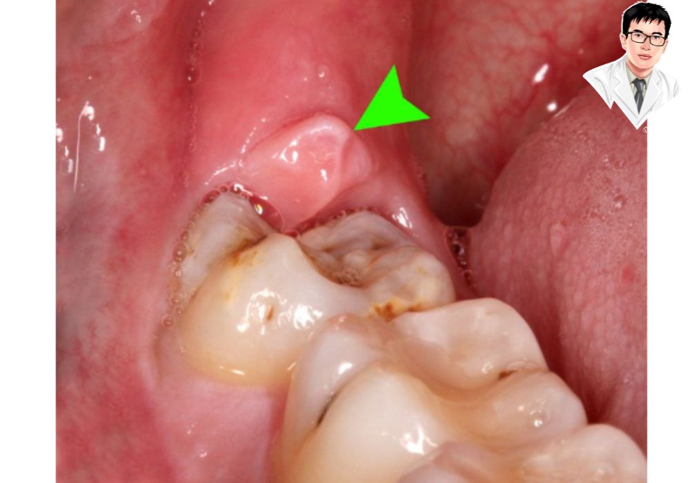 Răng khôn mọc lệch là nguyên nhân chính dẫn đến lợi trùm và nhiều vấn đề nha khoa khác. Răng khôn mọc lệch là nguyên nhân chính dẫn đến lợi trùm và nhiều vấn đề nha khoa khác.