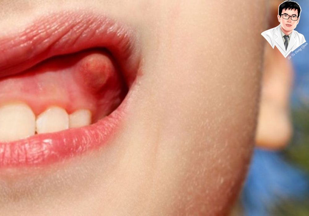 Hiểu rõ cấu trúc răng và lợi trùm giúp bạn nhận biết khi nào cần cắt lợi trùm để bảo vệ sức khỏe răng miệng. Hiểu rõ cấu trúc răng và lợi trùm giúp bạn nhận biết khi nào cần cắt lợi trùm để bảo vệ sức khỏe răng miệng.