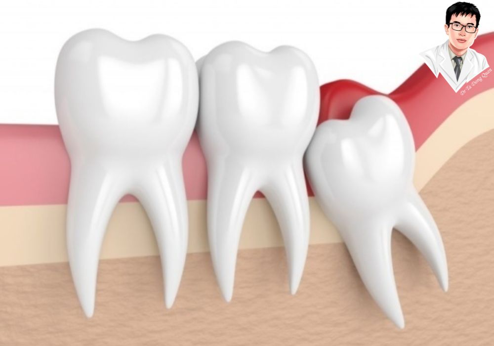 Đau và sưng tại lợi trùm là dấu hiệu phổ biến cần được xử lý kịp thời để tránh nhiễm trùng nặng hơn. Đau và sưng tại lợi trùm là dấu hiệu phổ biến cần được xử lý kịp thời để tránh nhiễm trùng nặng hơn.
