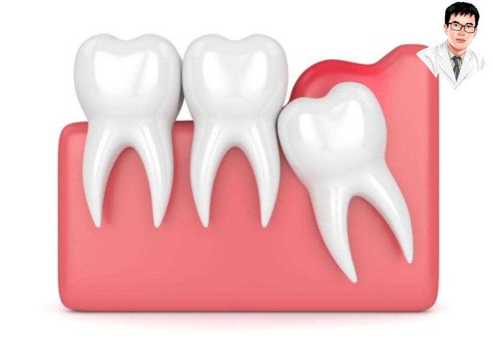 Răng khôn mọc ngầm thường kèm lợi trùm gây đau và cần được theo dõi hoặc can thiệp kịp thời. Răng khôn mọc ngầm thường kèm lợi trùm gây đau và cần được theo dõi hoặc can thiệp kịp thời.