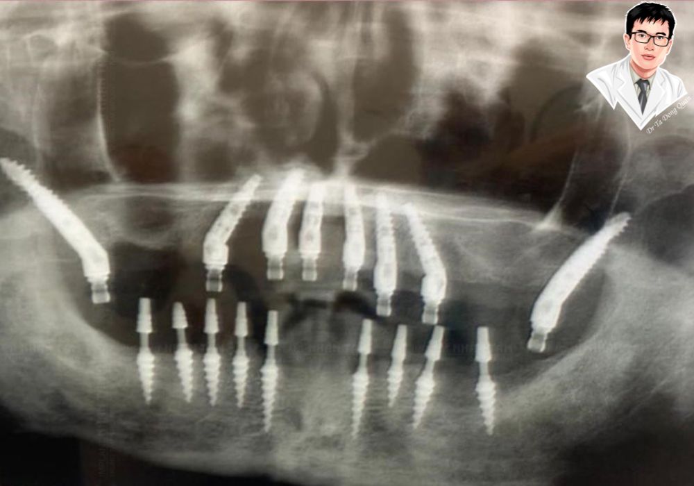 Ảnh chụp X-quang ca cấy implant chân bướm kết hợp implant thông thường ở nhiều vị trí. Ảnh chụp X-quang ca cấy implant chân bướm kết hợp implant thông thường ở nhiều vị trí.