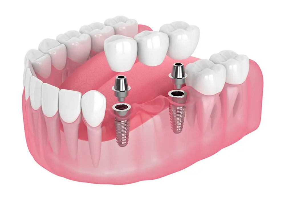 Trồng răng giả Implant và cầu răng sứ: Lựa chọn tối ưu cho sức khỏe và thẩm mỹ.