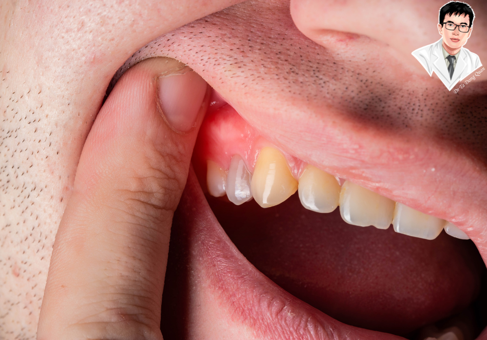 Viêm lợi kéo dài không đỡ? Đã đến lúc bạn nên dừng chữa tại nhà và gặp nha sĩ ngay! Viêm lợi kéo dài không đỡ? Đã đến lúc bạn nên dừng chữa tại nhà và gặp nha sĩ ngay!
