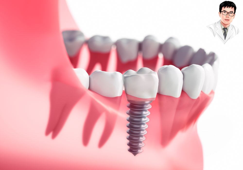 Kỹ thuật cấy ghép implant răng – giải pháp phục hồi răng tối ưu, bền chắc như răng thật. Mô hình minh họa kỹ thuật cấy ghép implant răng, thể hiện phần trụ implant được đặt vào xương hàm bên dưới nướu.
