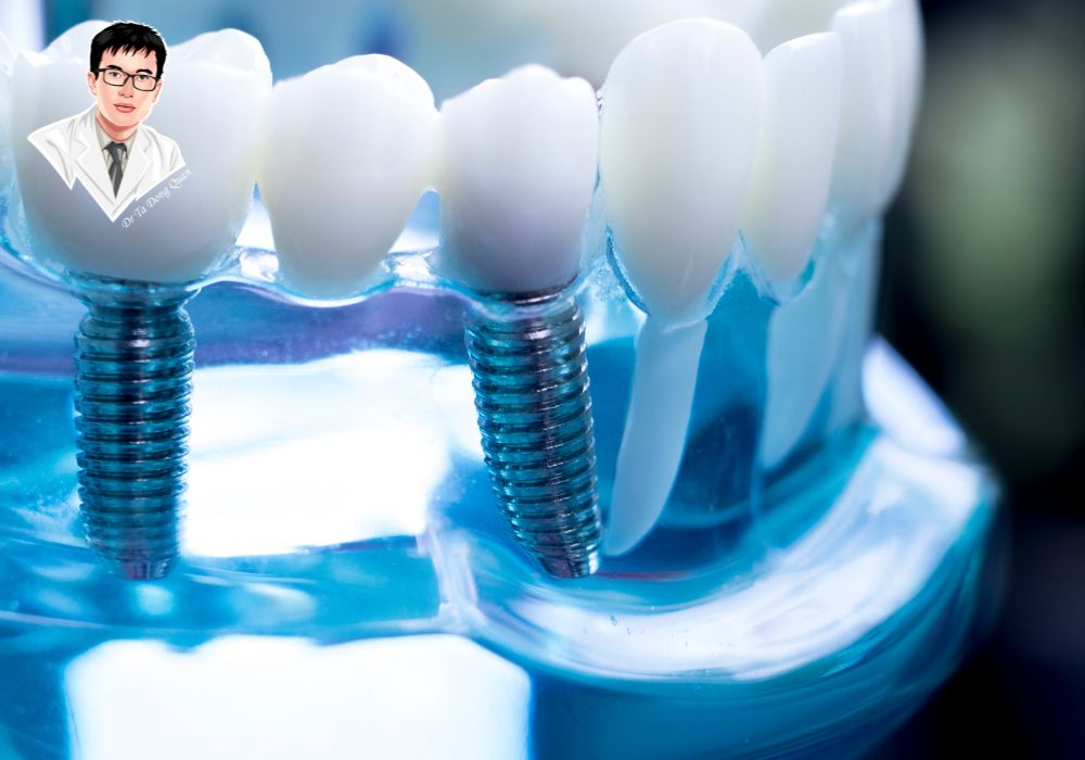 Phục hình implant răng thẩm mỹ, khôi phục chức năng ăn nhai tự nhiên. Hình ảnh kỹ thuật cấy ghép implant trên mô răng mẫu, thể hiện sự liên kết giữa trụ implant và mão răng sứ.