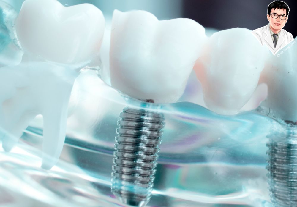 Công nghệ mô phỏng 3D hỗ trợ cấy ghép implant chính xác và an toàn. Mô hình 3D hiển thị trụ implant răng và các răng kế cận trong hàm, giúp hình dung rõ cấu tạo giải phẫu.
