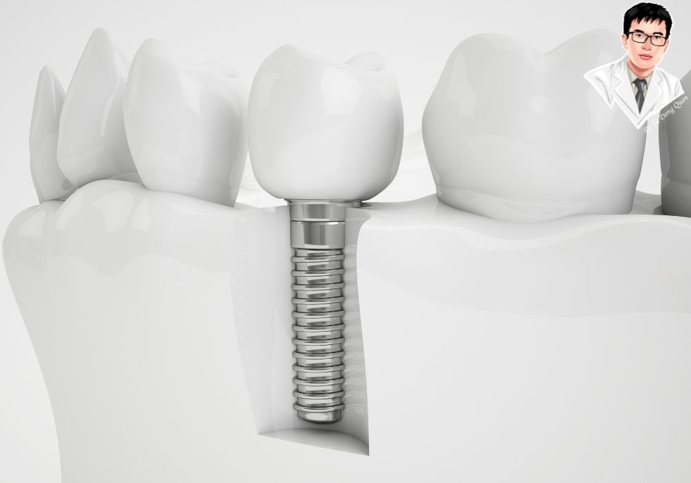 Mô hình trực quan 3D mô tả cấu trúc implant và mão sứ trong xương hàm, giúp người xem hình dung rõ ràng cách hoạt động của implant. Mô hình trực quan 3D mô tả cấu trúc implant và mão sứ trong xương hàm, giúp người xem hình dung rõ ràng cách hoạt động của implant.