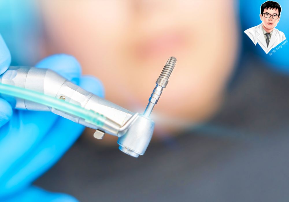 Chi phí implant bao gồm nhiều hạng mục – hiểu rõ để chủ động tài chính. Chi phí implant bao gồm nhiều hạng mục – hiểu rõ để chủ động tài chính.