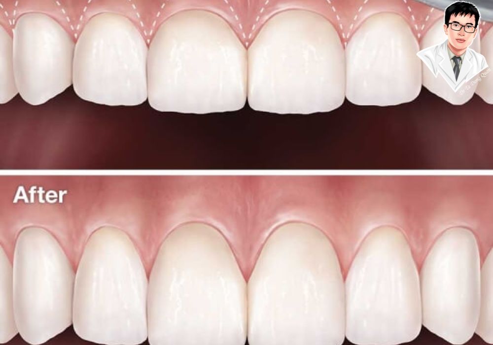 Đường viền lợi đều đẹp – Yếu tố then chốt của nụ cười hoàn hảo.