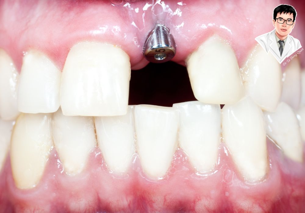 Trụ implant cố định sau khi cấy ghép – sẵn sàng cho bước phục hình mão răng. Trụ implant cố định sau khi cấy ghép – sẵn sàng cho bước phục hình mão răng.