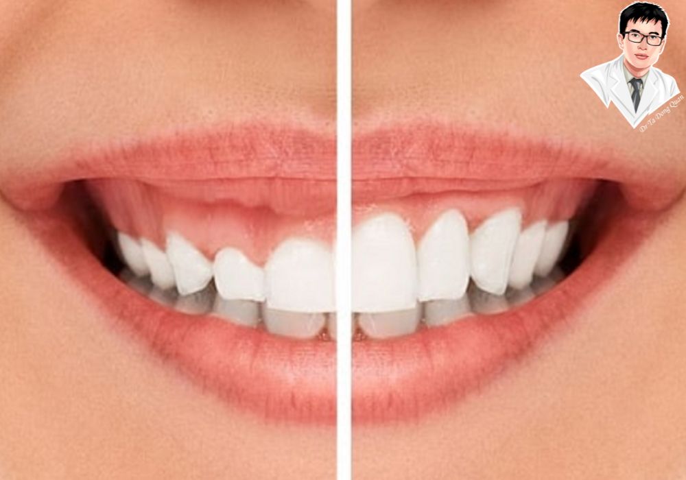 Hiệu quả bất ngờ sau phẫu thuật cắt lợi – Nụ cười đẹp chuẩn từng chi tiết.
