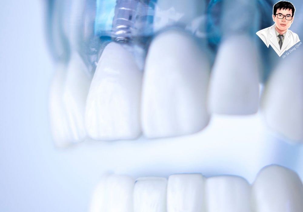Implant cố định toàn hàm không chỉ bền chắc mà còn đảm bảo thẩm mỹ, giúp bạn tự tin với nụ cười hoàn hảo. Implant cố định toàn hàm không chỉ bền chắc mà còn đảm bảo thẩm mỹ, giúp bạn tự tin với nụ cười hoàn hảo.