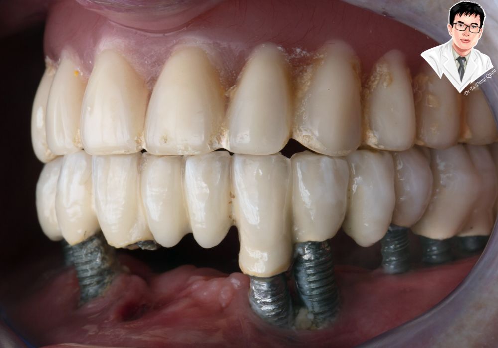 Implant cố định toàn hàm mang lại hàm răng chắc khỏe, thẩm mỹ tự nhiên, giúp phục hồi chức năng ăn nhai hiệu quả. Implant cố định toàn hàm mang lại hàm răng chắc khỏe, thẩm mỹ tự nhiên, giúp phục hồi chức năng ăn nhai hiệu quả.