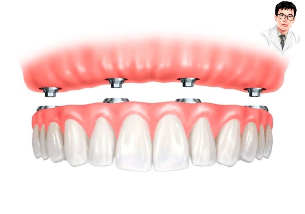 Mô hình mô phỏng hàm giả cố định gắn lên các trụ implant đã được bắt vít chặt vào xương hàm.