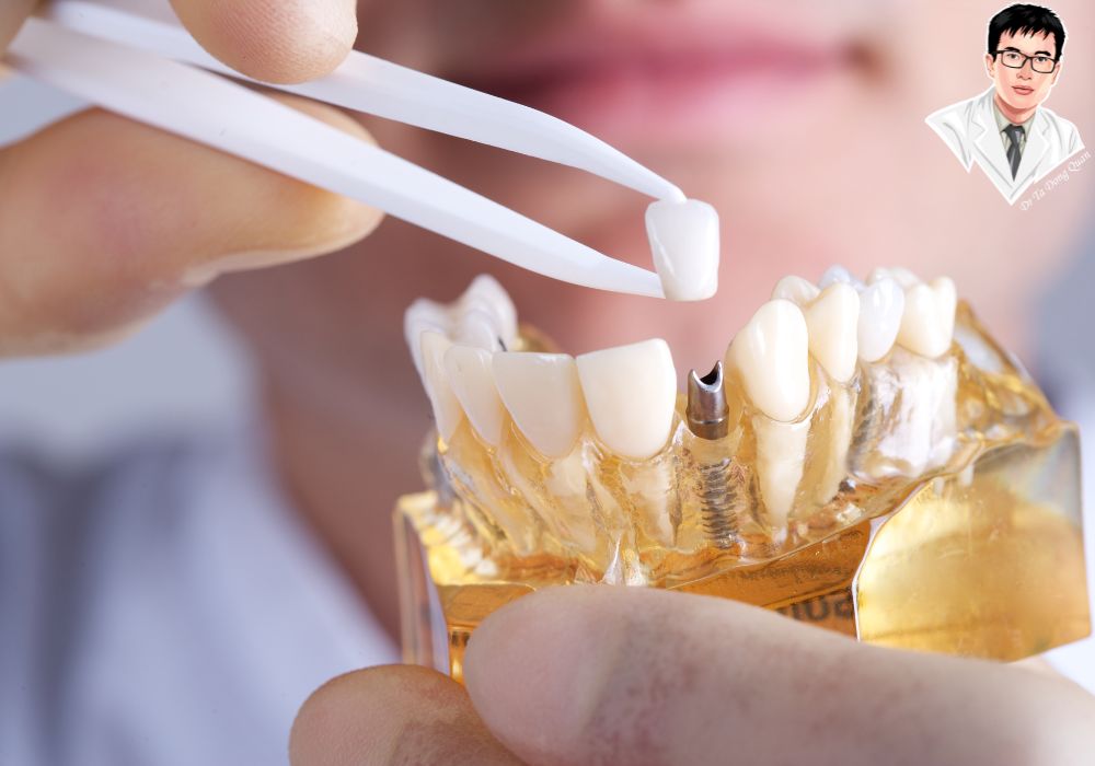 So sánh các bộ phận của răng implant với răng thật và mô mềm xung quanh, giúp phân tích hiệu quả và lợi ích khi sử dụng phương pháp này. So sánh các bộ phận của răng implant với răng thật và mô mềm xung quanh, giúp phân tích hiệu quả và lợi ích khi sử dụng phương pháp này.
