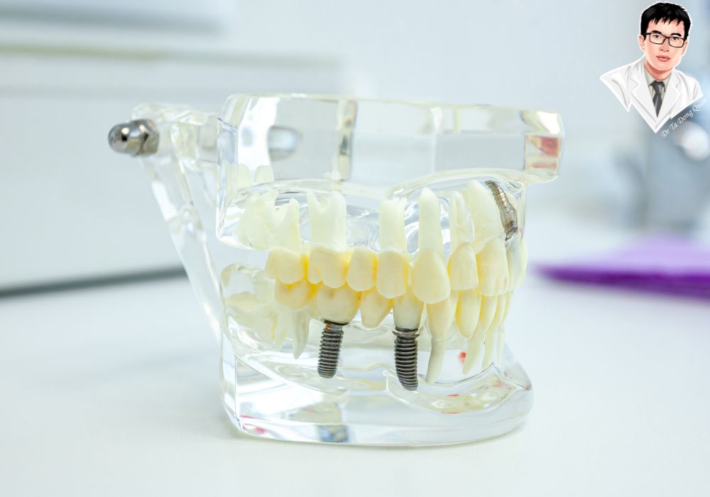 Mô hình implant phục vụ tư vấn y khoa giúp bệnh nhân nắm rõ quy trình và lợi ích của implant cố định toàn hàm. Mô hình implant phục vụ tư vấn y khoa giúp bệnh nhân nắm rõ quy trình và lợi ích của implant cố định toàn hàm.