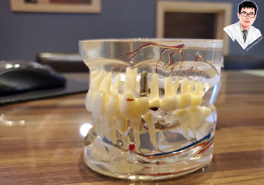 Mô hình implant hỗ trợ tư vấn và giải thích quy trình phục hồi răng nguyên hàm chính xác và chi tiết. Mô hình implant hỗ trợ tư vấn và giải thích quy trình phục hồi răng nguyên hàm chính xác và chi tiết.