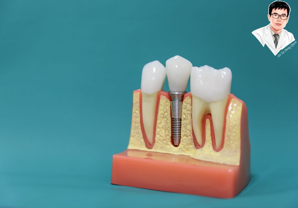 Implant răng hỗ trợ phục hồi chức năng nhai và ngăn ngừa tiêu xương hàm hiệu quả. Mô hình răng giả và trụ implant thể hiện chức năng ăn nhai và duy trì cấu trúc xương hàm.