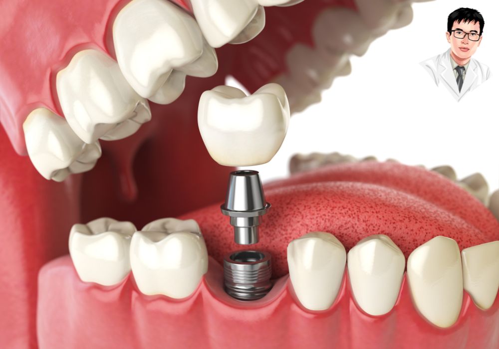 Minh họa quá trình cấy ghép implant – trụ được gắn cố định trong xương hàm Minh họa quá trình cấy ghép implant – trụ được gắn cố định trong xương hàm