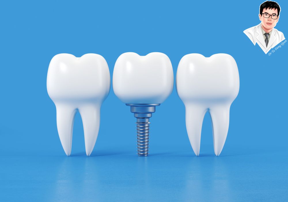 Hiểu đúng từng bước – giảm lo lắng và tăng cơ hội thành công khi trồng implant. Hiểu đúng từng bước – giảm lo lắng và tăng cơ hội thành công khi trồng implant.