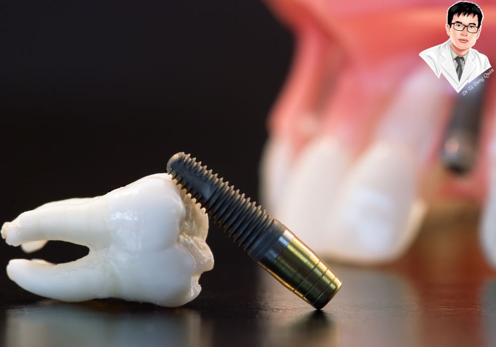 Implant không chỉ bền chắc mà còn giúp ngăn tiêu xương và bảo vệ cấu trúc hàm. Implant không chỉ bền chắc mà còn giúp ngăn tiêu xương và bảo vệ cấu trúc hàm.