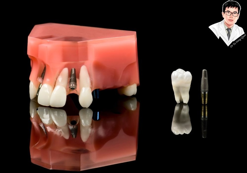 Mão răng sứ implant được hoàn thiện tỉ mỉ, đảm bảo độ vừa khít và thẩm mỹ cao. Quá trình hoàn thiện mão răng sứ implant, chuẩn bị gắn lên trụ implant trong môi trường phòng thí nghiệm.