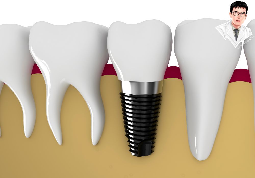 Từng bước kỹ thuật cấy ghép implant răng – bảo đảm thành công lâu dài. Minh họa chi tiết về các bước cấy ghép implant trong xương hàm và quá trình tích hợp trụ implant với xương.