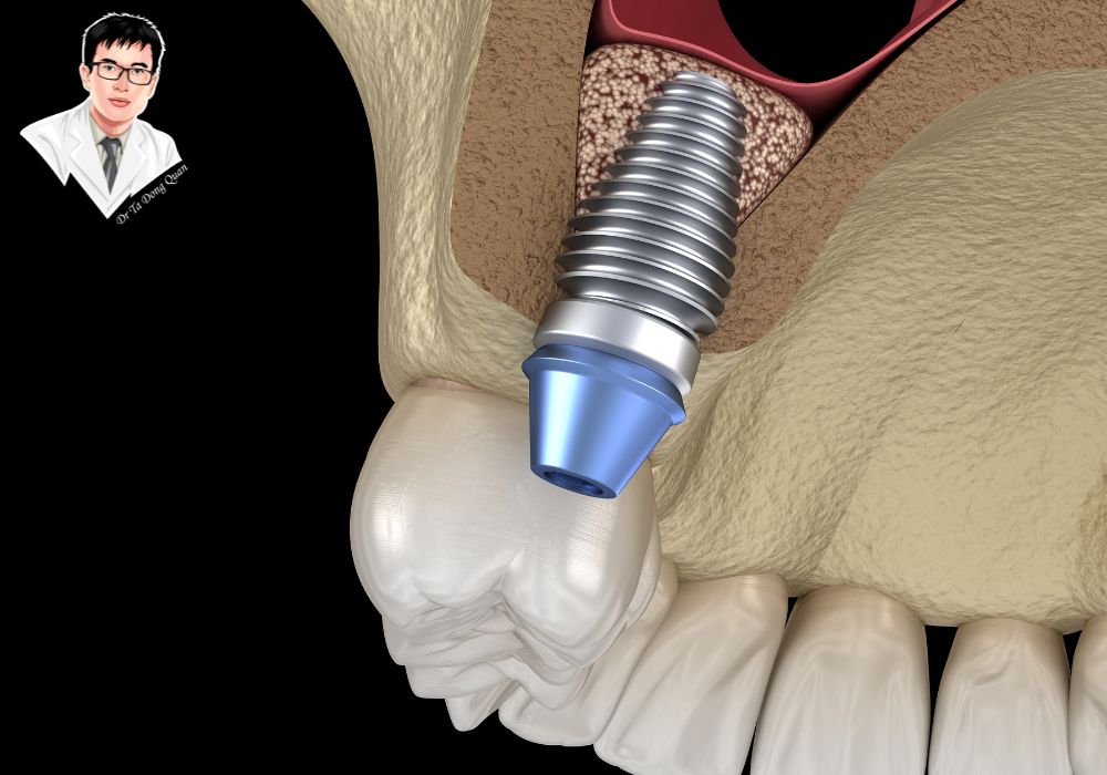 Ghép xương là giải pháp hỗ trợ cần thiết để tăng tỷ lệ thành công của ca implant. Ghép xương là giải pháp hỗ trợ cần thiết để tăng tỷ lệ thành công của ca implant.
