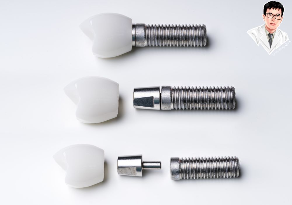 Các thành phần trụ implant, vít abutment và mão sứ được bố trí trên nền xám, minh họa quá trình phục hình từ cấy trụ đến hoàn thiện mão răng. Các thành phần trụ implant, vít abutment và mão sứ được bố trí trên nền xám, minh họa quá trình phục hình từ cấy trụ đến hoàn thiện mão răng.