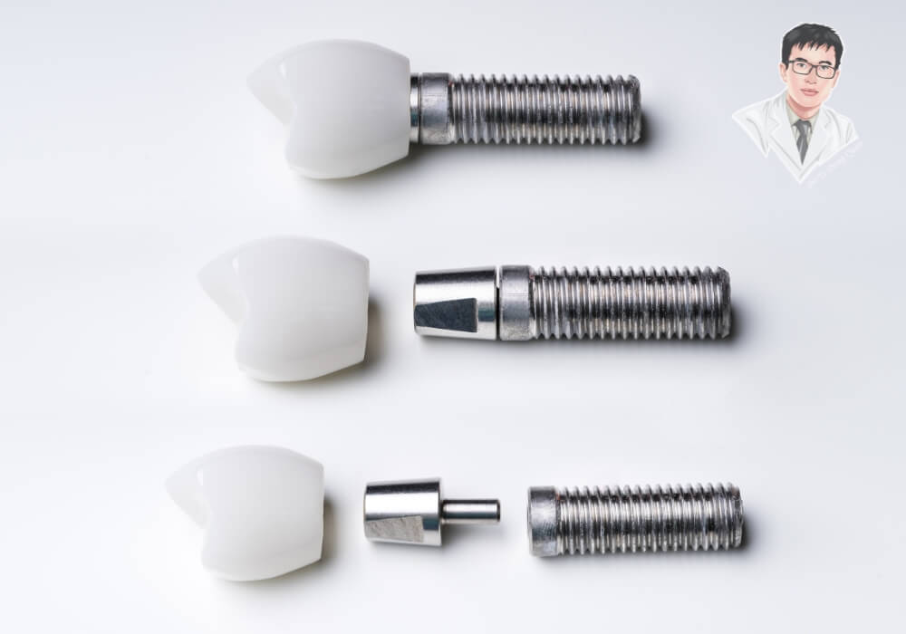  Ảnh cận cảnh cấu tạo đầy đủ của răng Implant gồm 3 phần: mão sứ, khớp nối và trụ Titanium, đặt trên nền trắng y tế.