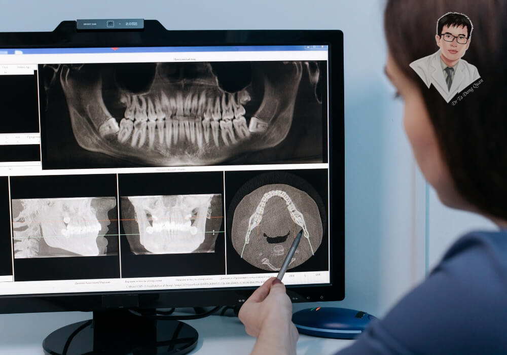 Bác sĩ đang phân tích phim chụp CT Cone Beam 3D để đánh giá xương hàm trước khi cấy ghép Implant.