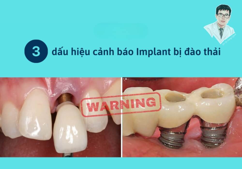 Tổng hợp các biểu hiện phổ biến cảnh báo implant có thể bị đào thải như viêm, tiêu xương, răng lung lay hoặc viêm mủ quanh trụ.