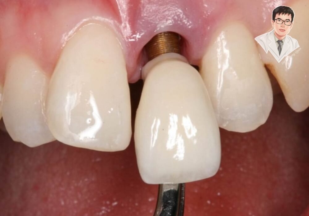 Trụ implant bị lung lay và lộ chân trụ là dấu hiệu báo động đỏ trước khi bị loại bỏ khỏi xương hàm.
