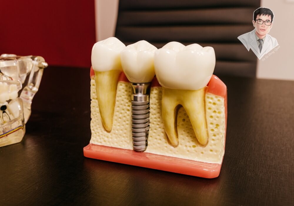  Mô hình minh họa cấu tạo răng Implant trên nền xương hàm, gồm trụ Titanium, Abutment và mão sứ, đặt tại phòng tư vấn nha khoa.