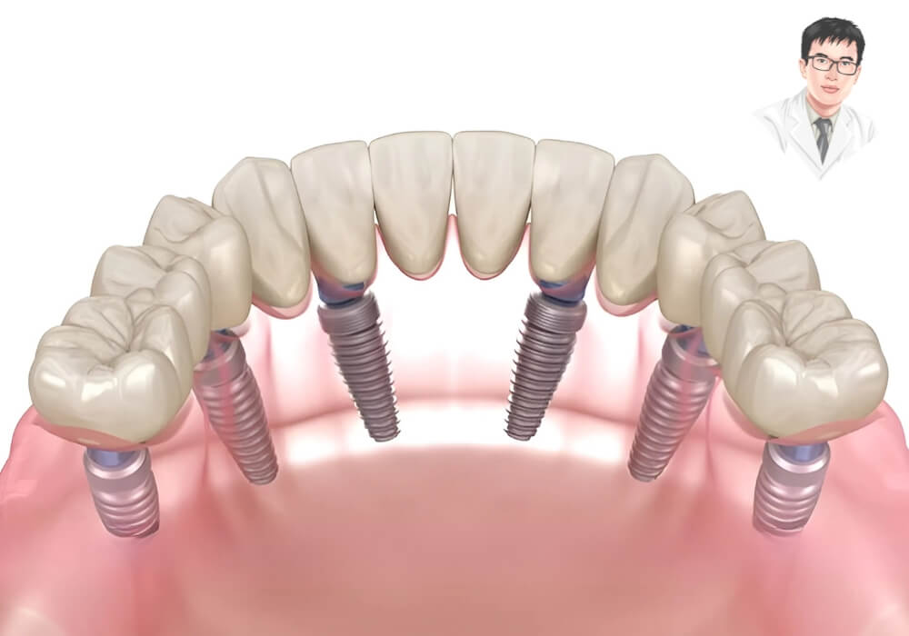 Mô phỏng kỹ thuật phục hình răng toàn hàm với nhiều trụ implant sau khi tháo bỏ các trụ cũ bị đào thải.