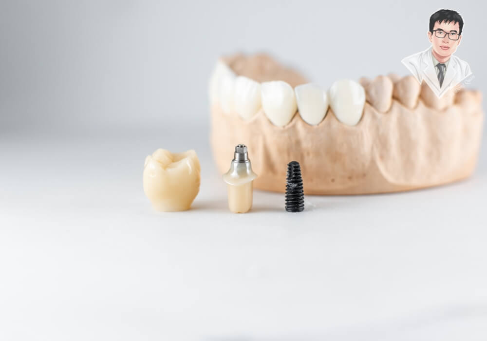 Hình ảnh mô phỏng cấu tạo đầy đủ của một chiếc răng Implant gồm mão sứ, khớp nối Abutment và trụ Implant đặt trên mô hình hàm, giúp hình dung các bước trong quy trình phục hình.