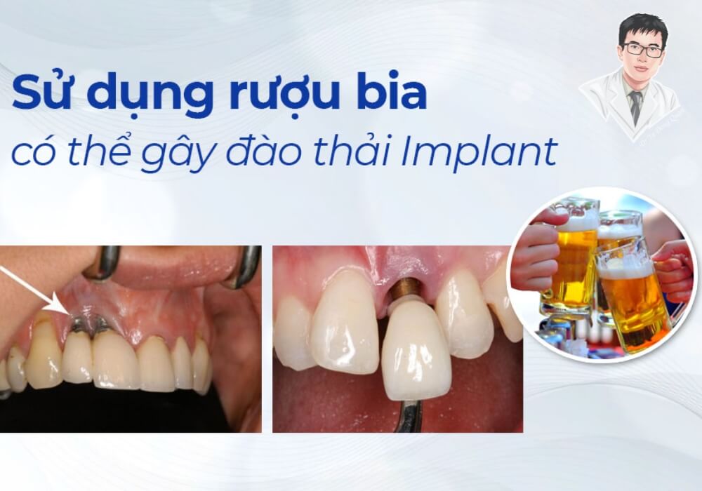 Uống rượu bia sau khi cấy ghép implant có thể cản trở quá trình lành thương và dẫn đến đào thải trụ răng.