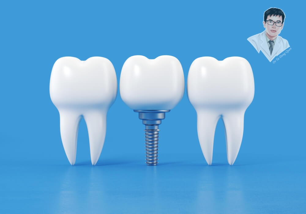 Hình ảnh so sánh răng thật và răng Implant trên nền xanh, làm nổi bật thiết kế trụ và mão sứ mô phỏng răng tự nhiên.