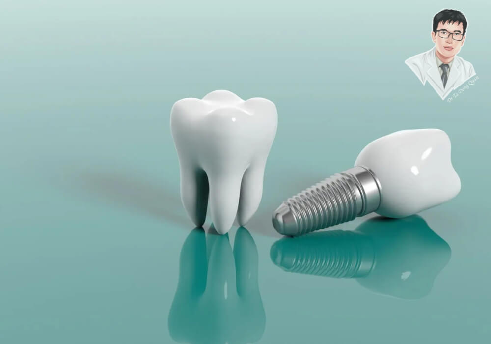 Hình ảnh trụ Implant và răng sứ bị tách rời, đặt cạnh răng thật mô phỏng, thể hiện khả năng trụ không tích hợp dẫn đến hiện tượng đào thải sau khi trồng Implant.