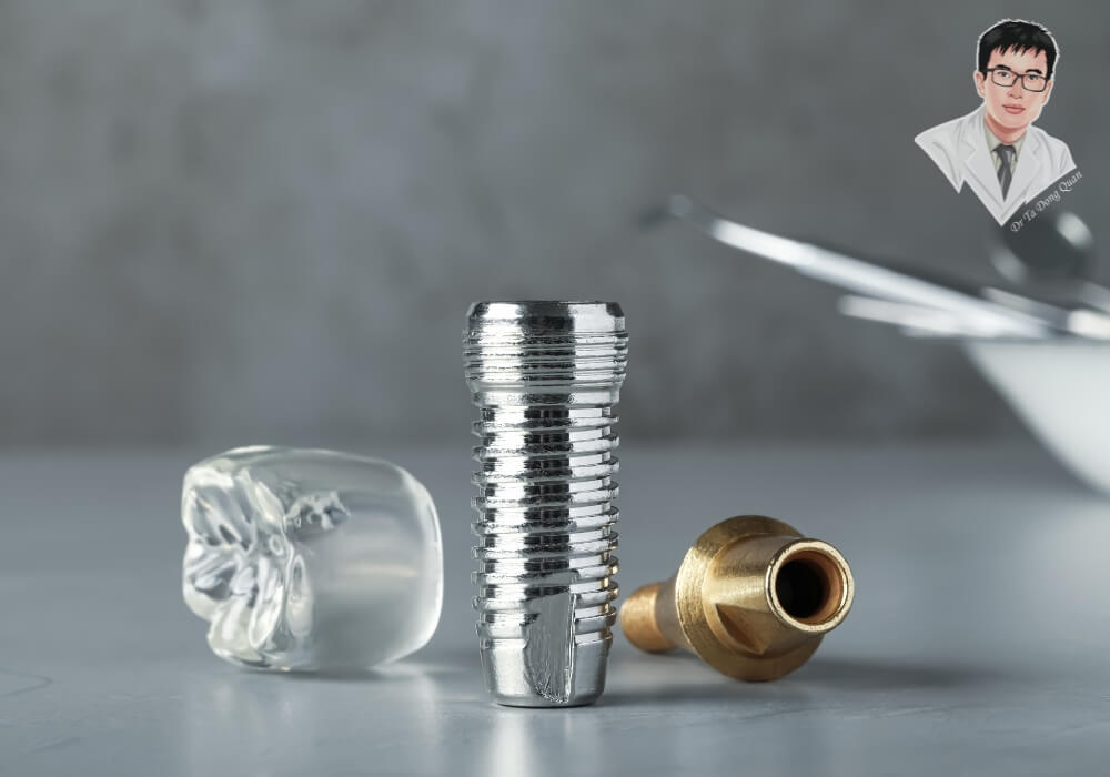 Bộ ba thành phần răng Implant gồm trụ titanium, abutment và mão sứ được trưng bày tách rời.