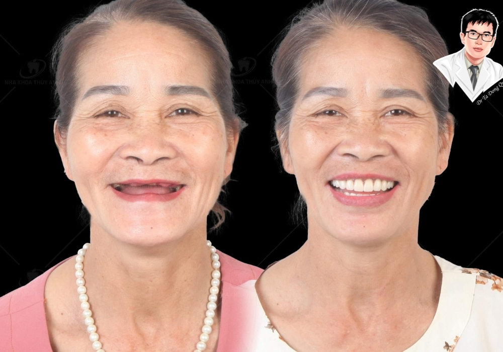 So sánh trước – sau khi cấy implant của một bệnh nhân nữ lớn tuổi, cải thiện rõ rệt cả nụ cười lẫn thần thái gương mặt. So sánh trước – sau khi cấy implant của một bệnh nhân nữ lớn tuổi, cải thiện rõ rệt cả nụ cười lẫn thần thái gương mặt.