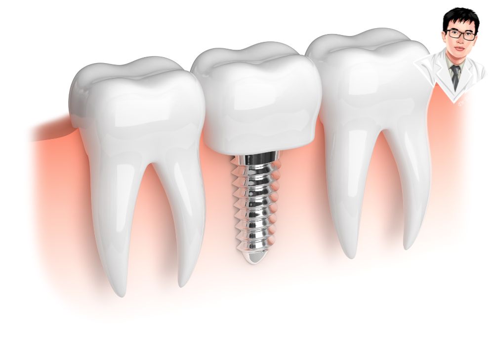 So sánh cấu trúc và chức năng giữa trụ implant và răng thật – gần như tương đồng