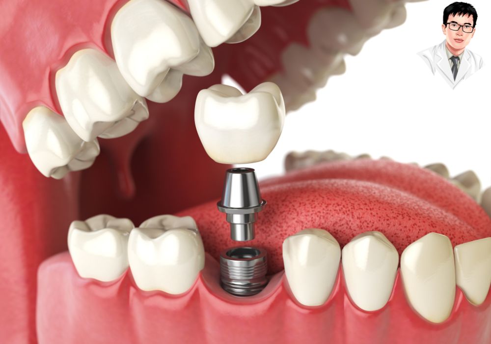 Nắm chắc các bước trồng răng implant giúp bạn yên tâm hơn khi điều trị. Nắm chắc các bước trồng răng implant giúp bạn yên tâm hơn khi điều trị.