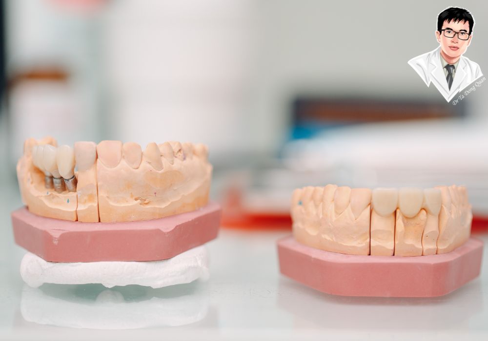 Trụ titanium chuẩn bị cấy vào xương hàm – vật liệu an toàn và bền bỉ. Trụ titanium chuẩn bị cấy vào xương hàm – vật liệu an toàn và bền bỉ.